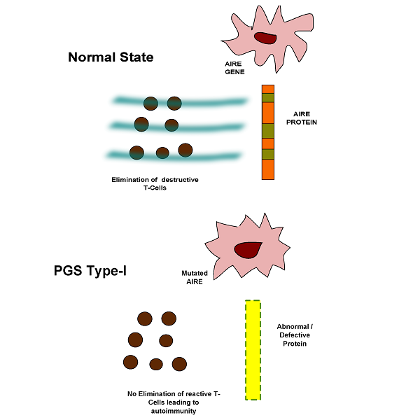 Autoimmune Polyglandular Syndrome Type 1: An Illustrative Overview